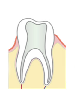 虫歯を除去