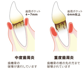 重度歯周病